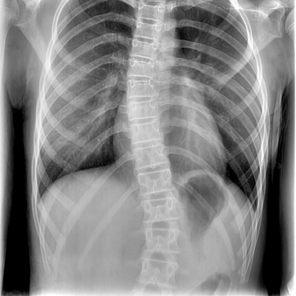 X-ray of thoracic scoliosis.