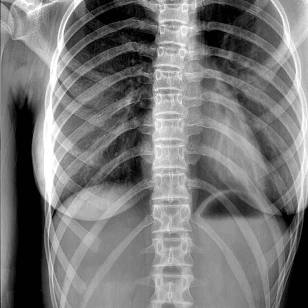 X-ray of thoracic spine after using the ScoliBrace.