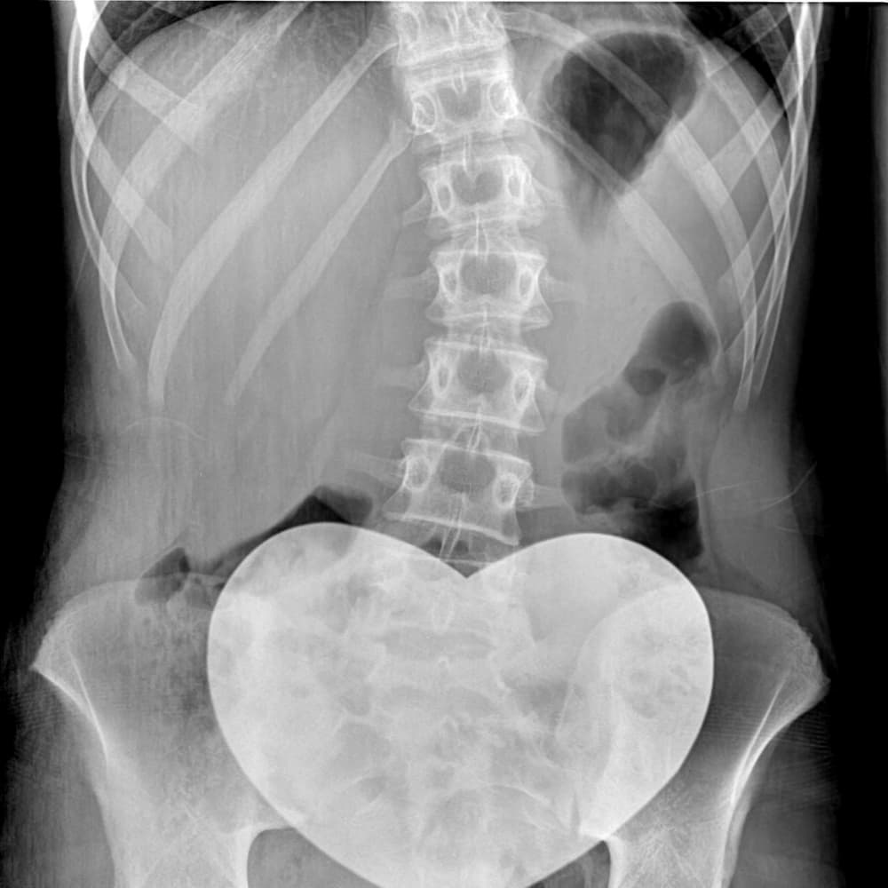 X-ray of the lumbar spine scoliosis.