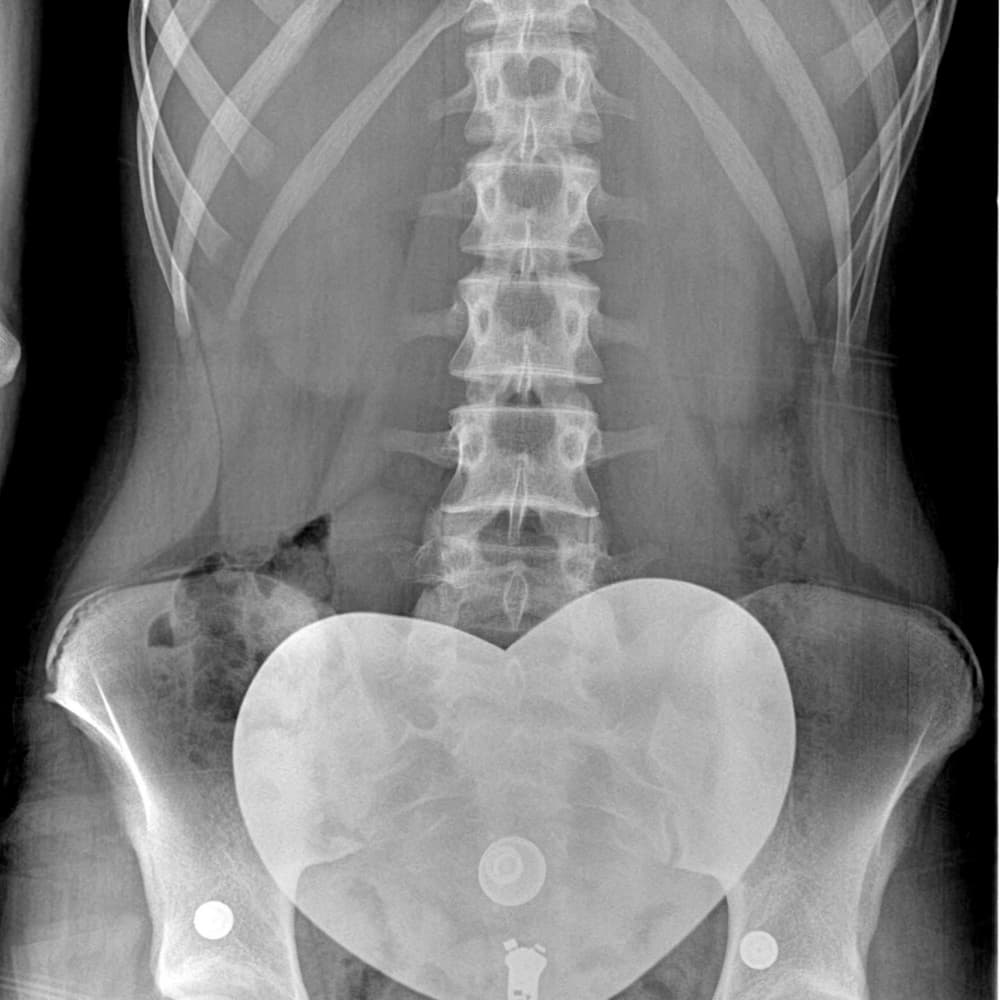 X-ray of lumbar spine after using the ScoliBrace.