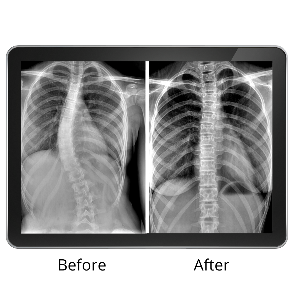 X-rays on an iPad demonstrating the effectiveness of ScoliBrace on thoracic scoliosis.