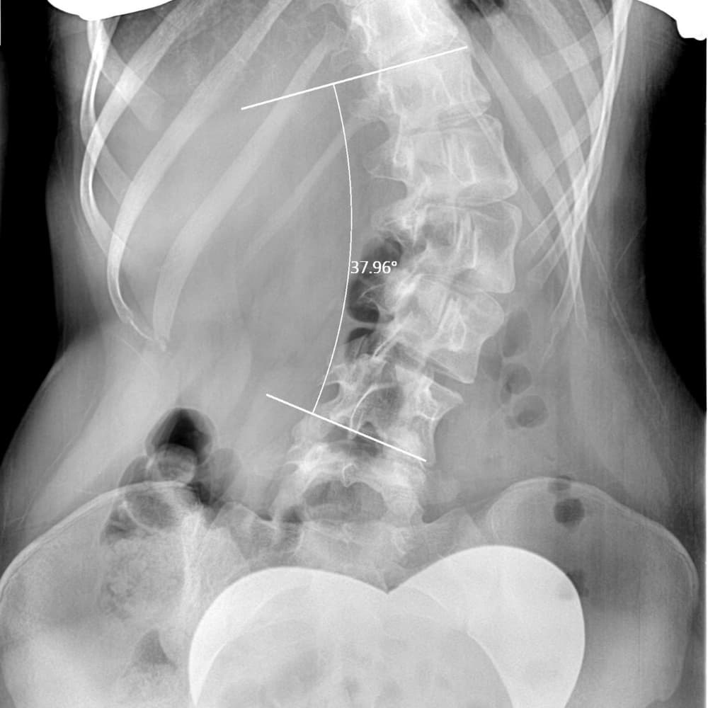 X-ray showing scoliosis of the lumbar spine.