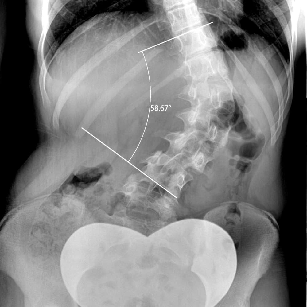 X-ray showing scoliosis of the lumbar spine.