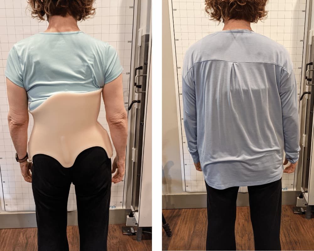 Rear view of female patient wearing the ScoliBrace over and under clothes.